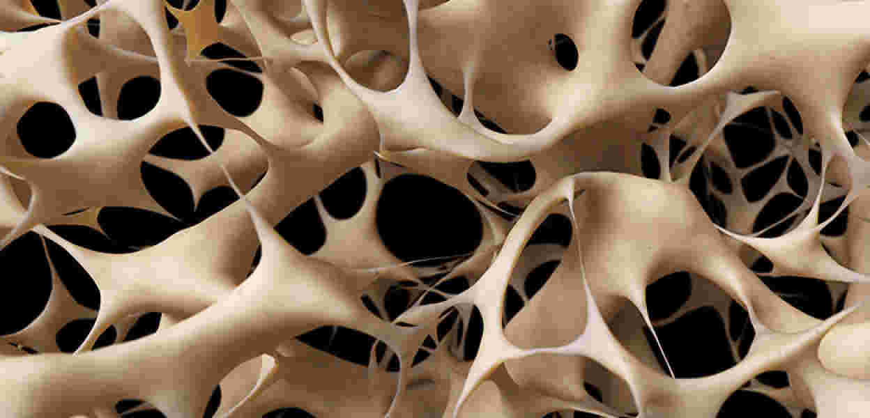 Ousting Osteoporosis
